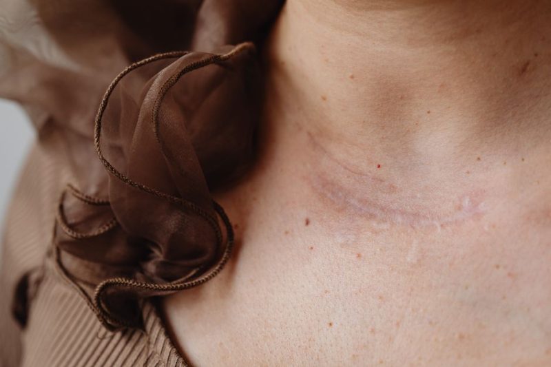Scar Tissue Treatment Options: Natural & Advanced Therapies